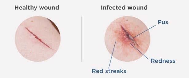 Healthy wound vs infected wound